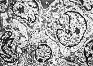 53. F,43y. | spleen - hairy cell leukemia